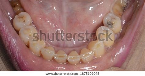 67 Attrition Teeth Stock Photos, Images & Photography | Shutterstock