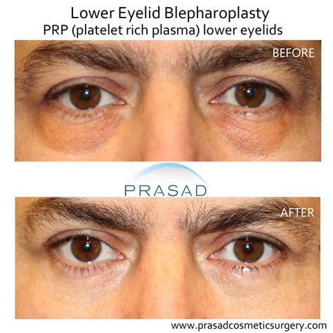 Benefits of PRP Injection Under Eyes - Dr. Prasad | New York