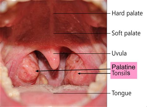 Tonsillitis Or Strep Throat What Do Swollen Lymph Nod - vrogue.co