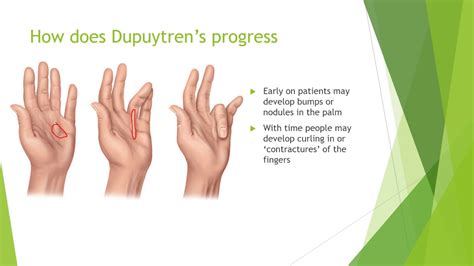 Dupuytren's Contracture Treatment - Everything You Need to Know - YouTube