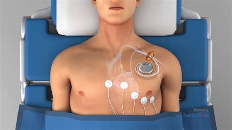 Pacemaker Video | Medical Video Library