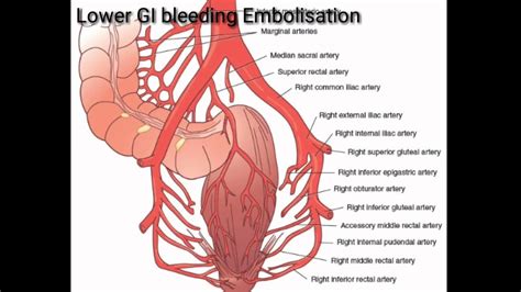 Lower GI bleeding| Bleeding PR|Endovascular treatment by Embolisation|Emborrhoids for bleeding ...