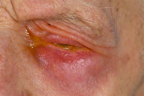 Identifying and Treating Seborrheic Dermatitis on the Eyelid ...