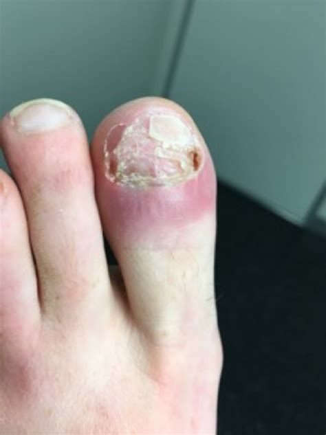 Case Discussion: A 40yo Lady With Rare Fungal Bone Infection as Cause of Chronic Toenail Deformity