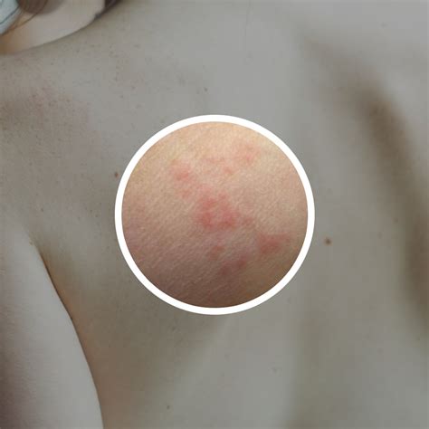 Rash Treatment for Bed Bugs - Quick Remedies to Relieve a Rash Caused ...