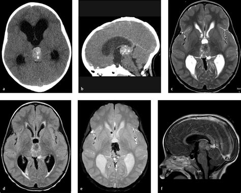 11 Simple Pineal Cyst | Radiology Key