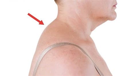 Ways To Improve Your Neck Hump - Rehabcure - Best Rehabilitation Center ...