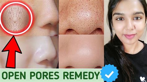 No More Large Open pores/Bumps/Blackheads/Whiteheads/clogged pores| How to get rid of open pores ...