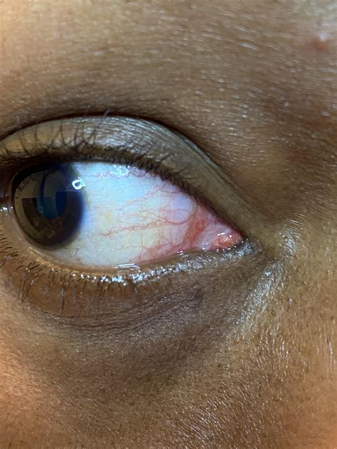 Both of my eyes are covered in veins and I can't seem to find the answeras to why. : r/optometry