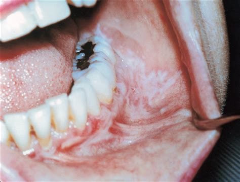 White Oral Lesions: How to Distinguish the Benign From the Deadly ...