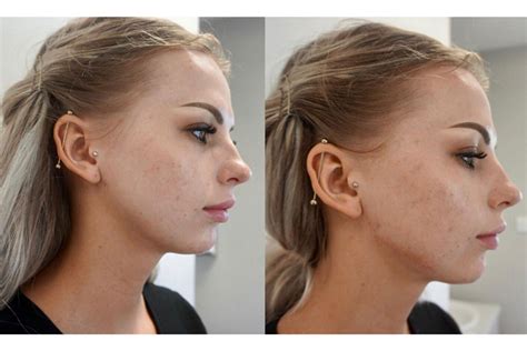 Jawline Contouring Dublin - Jawline Filler - Facial Rejuve