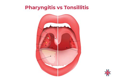 Pharyngitis: A Comprehensive Guide to Symptoms, Causes, Prevention and Treatment | ER of Mesquite