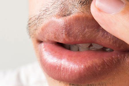 Fordyce Spots on the Lips: Causes, Symptoms, & Treatment