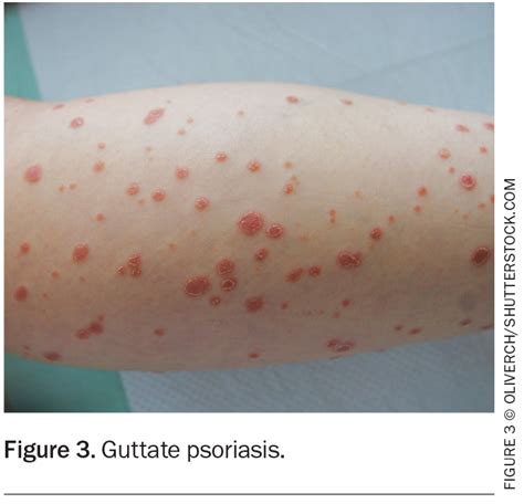Psoriasis In Children: Symptoms, Types How To Deal With It, 50% OFF