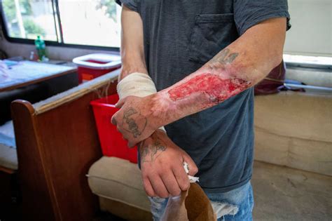 Xylazine causes open wounds, making the illegal drug supply even more dangerous : NPR