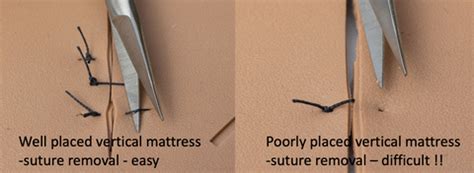 Vertical Mattress Suture How-To | Dr. David Naysmith | Suture Mentor