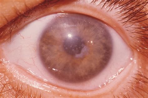 Cornea on emaze