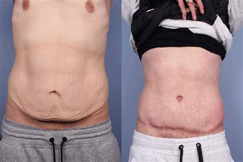 Before and after mini tummy tuck recovery - heavyfas