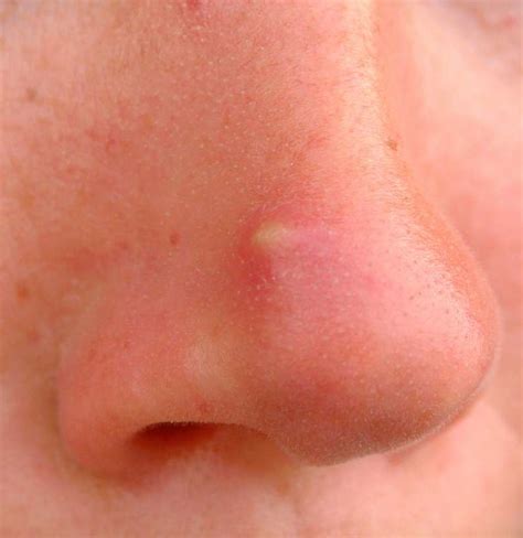 Cyst on nose: 5 Detailed Causes, Symptoms and Treatment