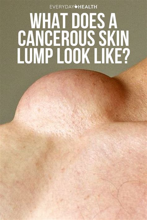 What Does a Cancerous Skin Lump Look Like? | Skin, Epidermoid cyst ...