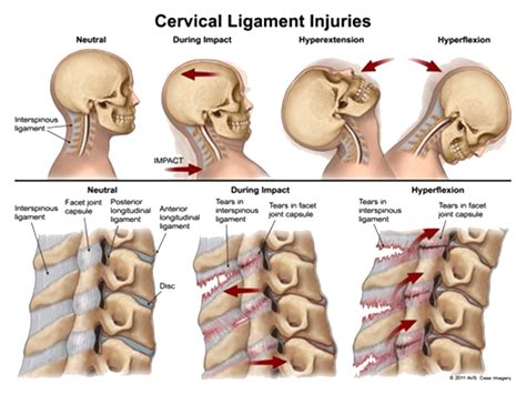 ANAT Whiplash Injuries Of Head Neck, Laminated | canoeracing.org.uk