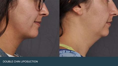 Double Chin Surgery Liposuction Phoenix | Phoenix Liposuction