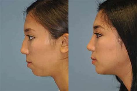 Non Surgical Chin Correction/Augmentation in Gurgaon, Delhi NCR