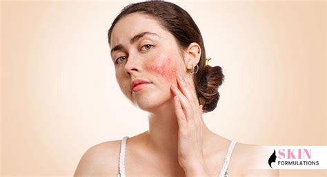 Skin Redness: Types, Causes, Treatments, And Home Remedies