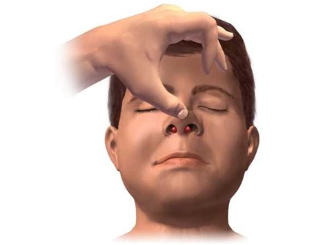 Deviated Nasal Septum: Symptoms and Treatments - TV Health