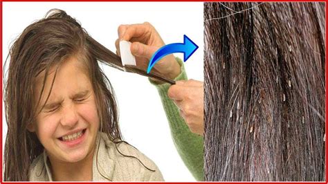 How to remove nits from Hair at Home without a Comb permanently! - YouTube