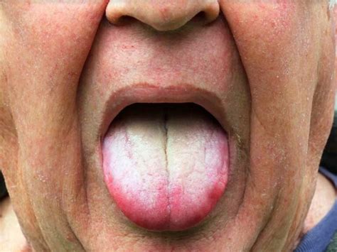 White Tongue Causes & 11 Natural Remedies to Make It Healthier - Origin ...