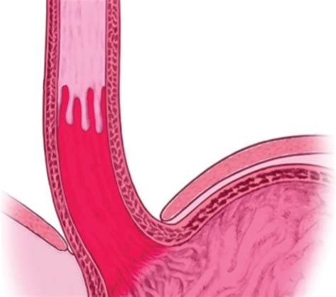 Endoscopy for Barrett’s Esophagus