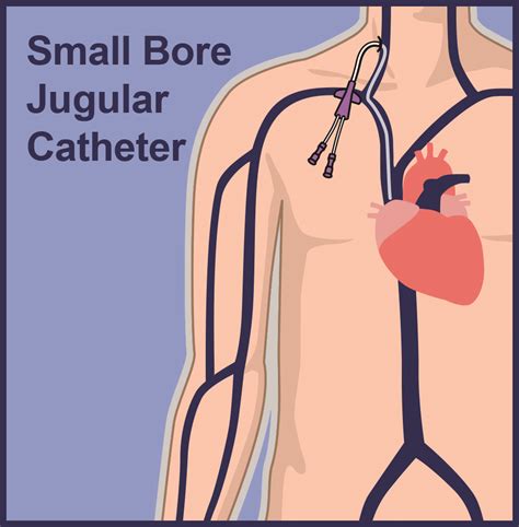 Central Venous Catheter Lines | Vascular Wellness