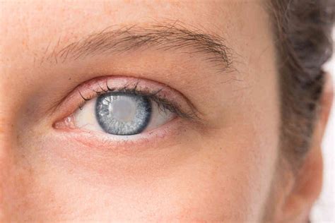 Common Eye Diseases: List of Most Common Eye Diseases in India, Symptoms & Treatment