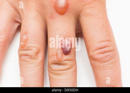 Man's hand covered with blisters caused by cryosurgery - wart removal procedure using liquid ...