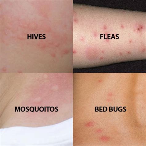 What Do Bedbug Bites Look Like Compared To Mosquito Bites at Kathleen Isaacs blog