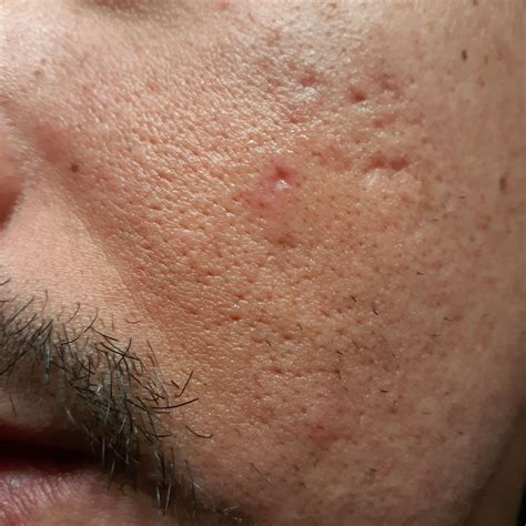 Help! Severe acne scars - Scar treatments - Acne.org