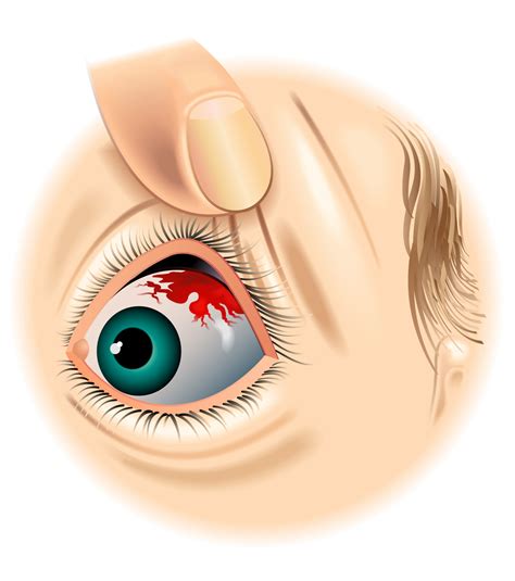 7 Causes of a Red Spot on Your Eye (And How to Treat Them)