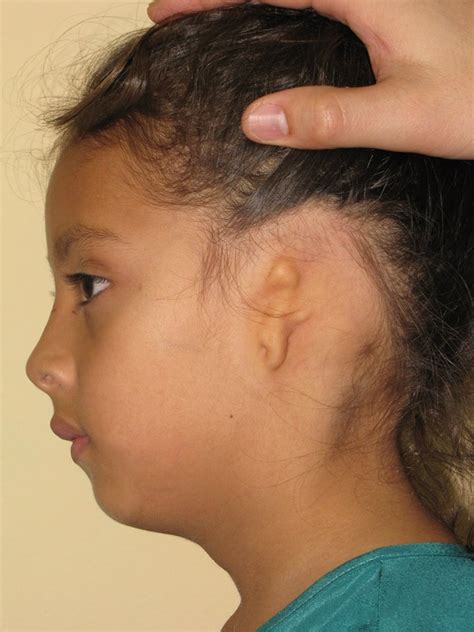 Microtia & Atresia Repairs | Richmond ENT