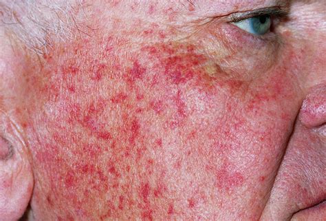 Petechial Rash Photograph by Dr P. Marazzi/science Photo Library