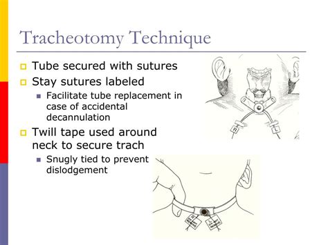 PPT - Pediatric Tracheostomy PowerPoint Presentation, free download ...