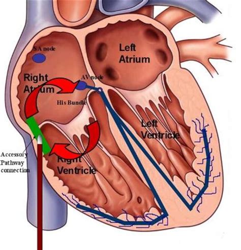 The Implantable Medtronic Cardiac Loop Recorder: A Personal Experience ...