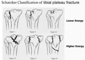 Tibial Plateau Fracture Surgery | Symtoms, Treatment & Recovery