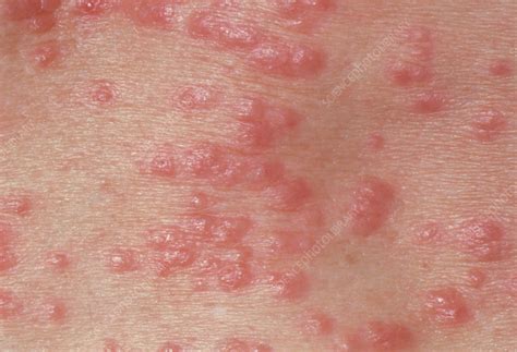 Red papules on the skin due to scabies - Stock Image - M260/0127 - Science Photo Library