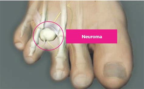 Why are Podiatrists still removing the nerve in Mortons Neuroma surgery? - Podiatry Posts