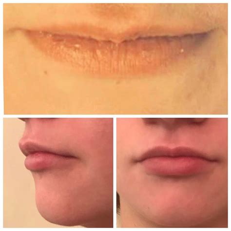 Before and after client lip augmentation Subtle & natural result. For ...