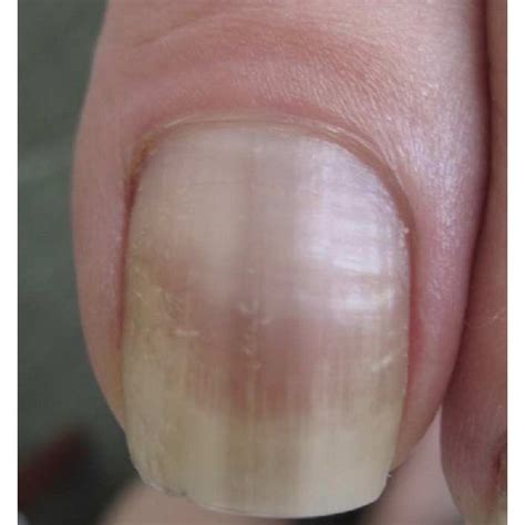 Hutchinson's sign in a nail apparatus melanoma in situ. | Download Scientific Diagram