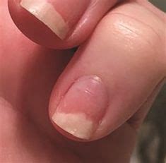 Common nail disorders and disease