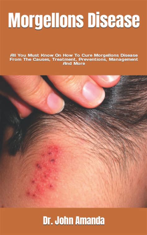 Morgellons Disease: All You Must Know On How To Cure Morgellons Disease From The Causes ...