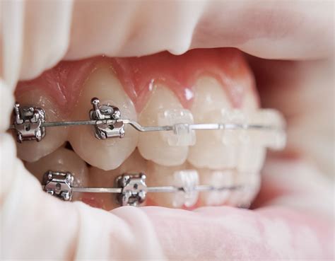 Ceramic Braces | Clear Orthodontic Options